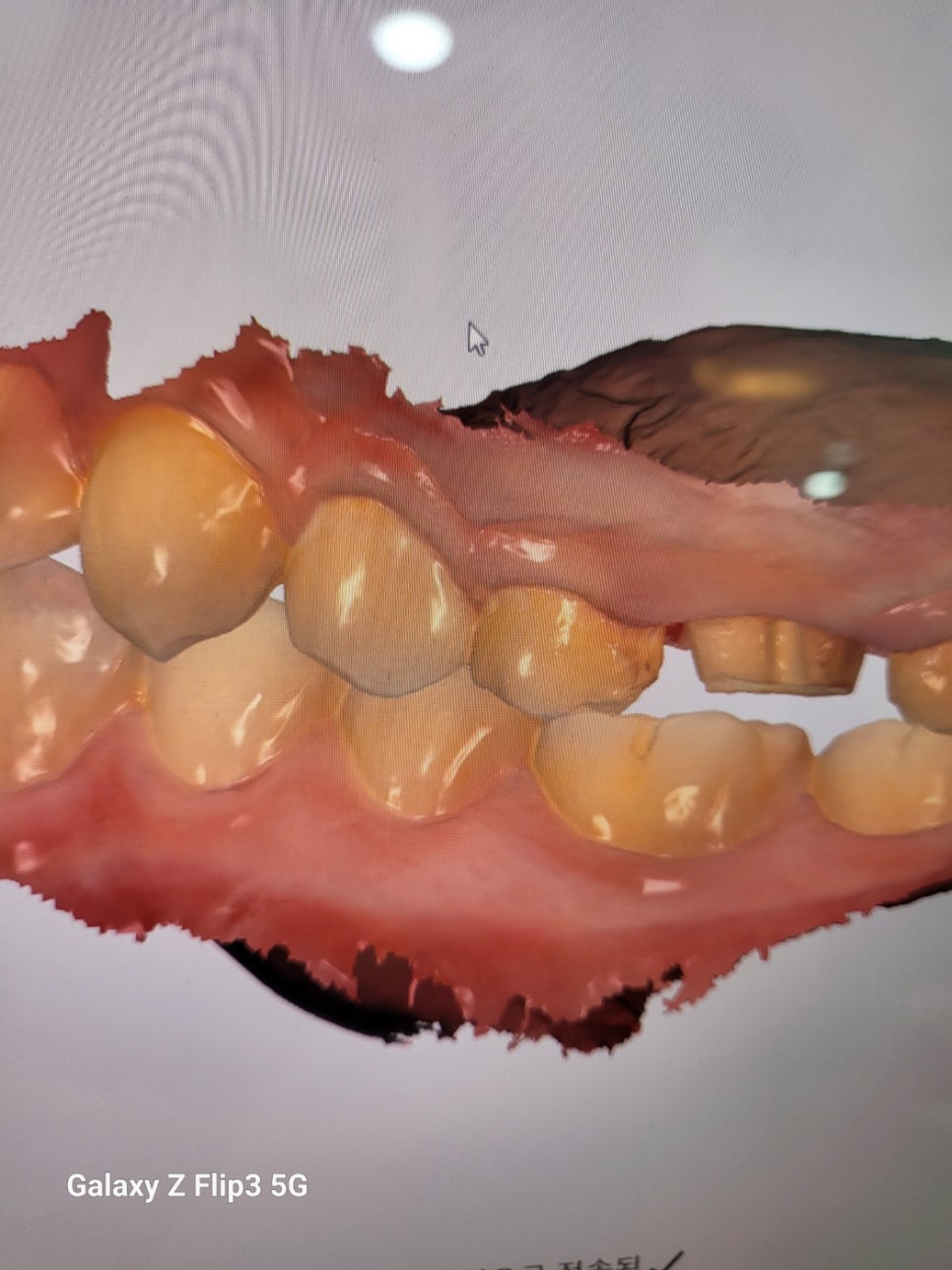 Have You Found Dental Impressions Difficult? Every Dental Clinic Has Introduced an Intraoral Scanner. image 3