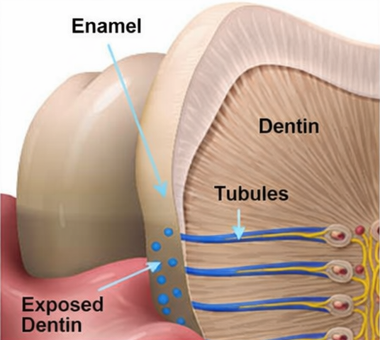 강서 치과 에서 알아보는 치아 사이 인접면 충치의 위험성 (ft. 정기검진의 중요성) 관련 이미지 4