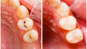 The Difference Between Resin and Ceramic You Must Know Before Cavities Treatment at Balsan-dong Dental Clinic image 2
