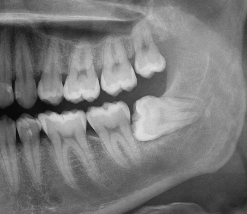 마곡동 치과 사랑니 발치 후 2~3일째 통증과 냄새가 느껴진다면? 드라이소켓 주의 관련 이미지 3