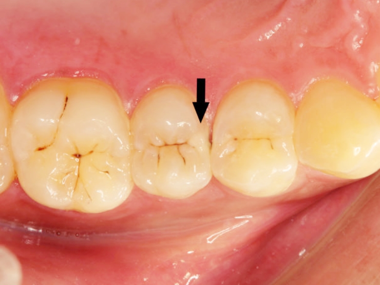 갑자기 이가 시려요. 에브리 치과 의원에서 알려드리는 여름철치아관리법 관련 이미지 4