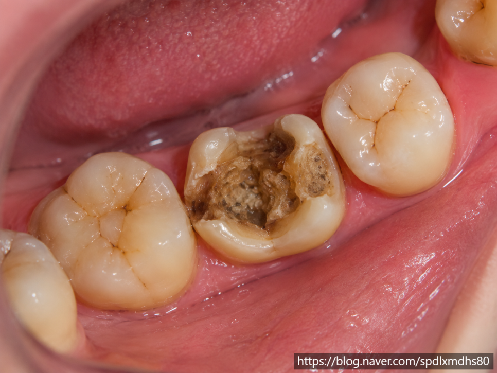 Root Canal Treatment at Magok Station: The Pain Is Gone—Do I Still Need to Continue Treatment? image 3