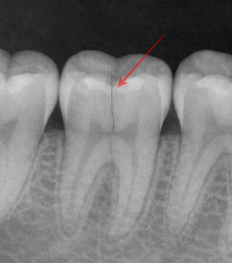 발산동 치과 씹을 때만 찌릿한 통증, 충치가 아닐 수 있습니다 — 치아 균열 증후군 관련 이미지 6