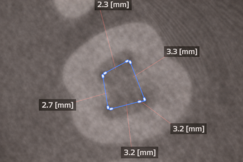 마곡동 치과 신경치료, 뿌리 모양이 이상하다면? MB2/Radix Entomolaris 관련 이미지 4