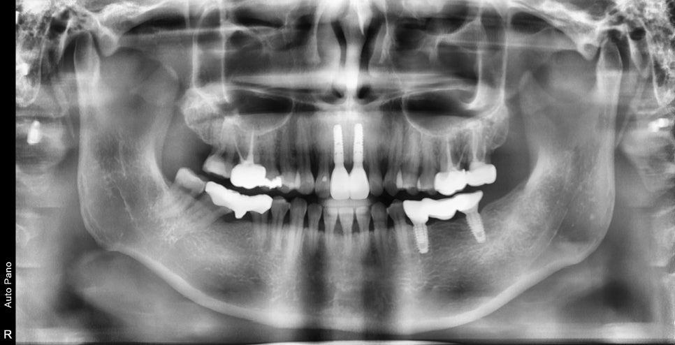 What Matters More Than the Price of Implants at Sumyeongsan Dental Clinic: What Should You Consider for Long-Term Use? image 3