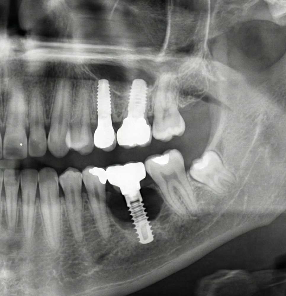 우장산 치과 잇몸 뼈가 녹는 이유와 임플란트 기능 회복을 위한 단계 관련 이미지 4