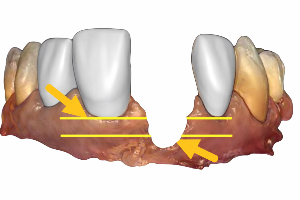 우장산 치과 발치 후 임플란트 안 하면? 치아 정출 &bull; 치축 경사 &bull; 치조골 흡수 관련 이미지 4
