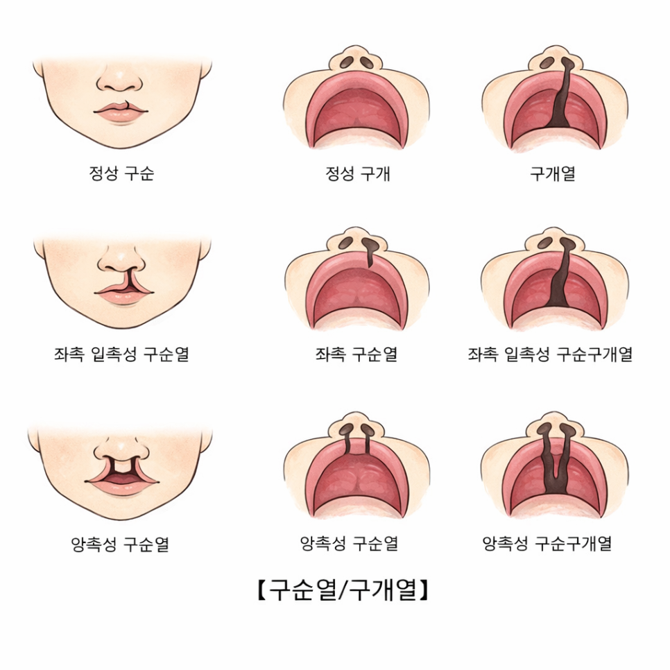 아이 입술&middot;입천장이 벌어졌다면? 마곡동 치과 의 구순구개열 구강 정보 관련 이미지 2