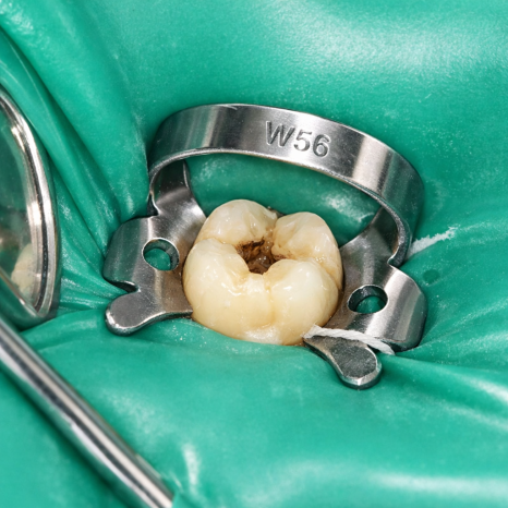 발산역 치과, 치료에서 많이 쓰이는 도구 러버댐에 대해 자세히 알아보기 관련 이미지 3