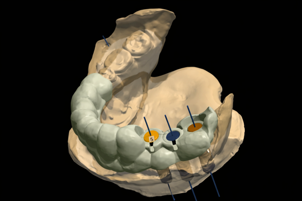 발산동 치과 네비게이션 임플란트 과정 알려드립니다. 관련 이미지 1