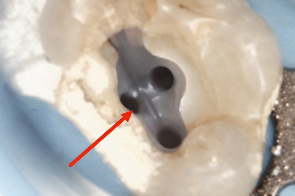 마곡동 치과 신경치료, 뿌리 모양이 이상하다면? MB2/Radix Entomolaris 관련 이미지 3