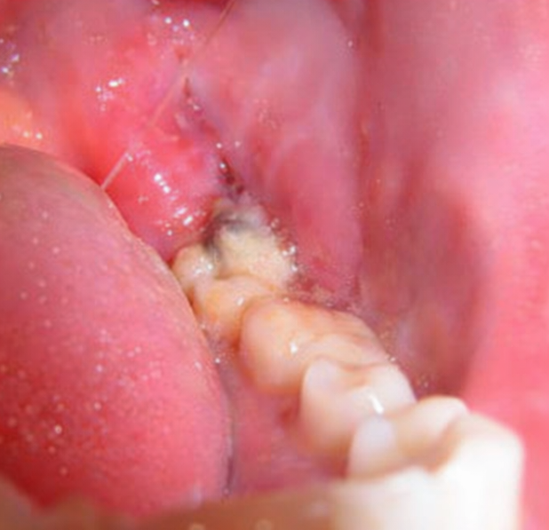 Maguok-dong Dental Clinic: If your gum keeps swelling around your wisdom tooth, let’s look at the causes of pericoronitis and how to manage it! image 3