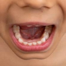 내발산동 치과 아프지 않아도 닳고 있다, 치아 마모증이 위험한 이유 관련 이미지 4