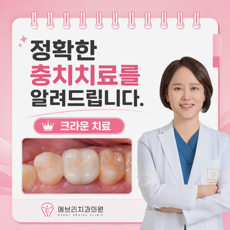 내발산동 충치치료, 레진으로 될까요? 레진, 인레이, 크라운 선택의 기준 관련 이미지 11