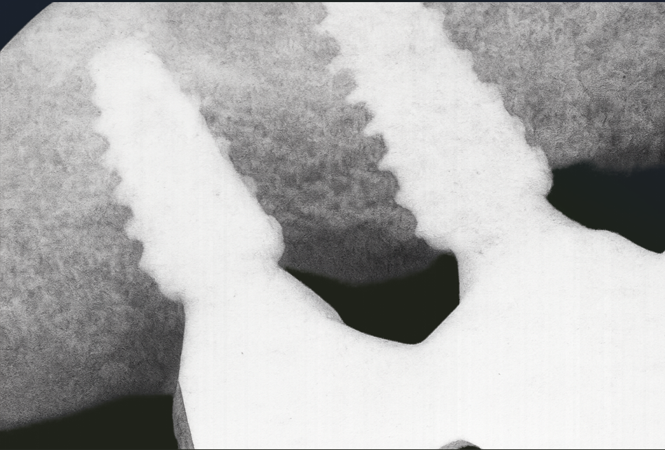 발산동 치과 리쥬란이라 불리는 PDRN 잇몸 치료 & 골이식 관련 이미지 5