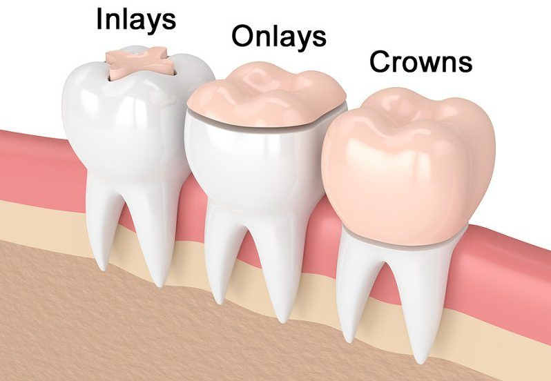 The Difference Between Resin and Ceramic You Must Know Before Cavities Treatment at Balsan-dong Dental Clinic image 4