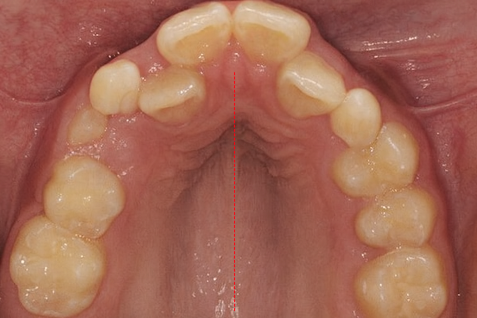 내발산 치과 악궁확장, 1차 or 2차 올바른 소아교정 시기는? 관련 이미지 2
