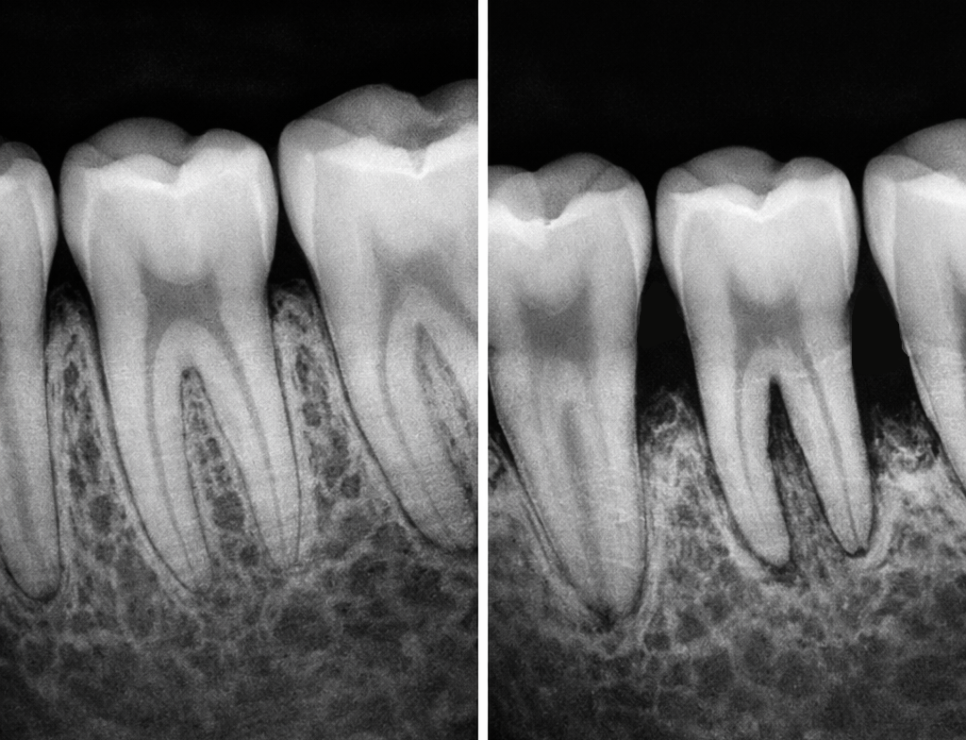 강서 치과 발치 즉시 임플란트, 나도 할 수 있을까? 가능한 조건과 장점 관련 이미지 1