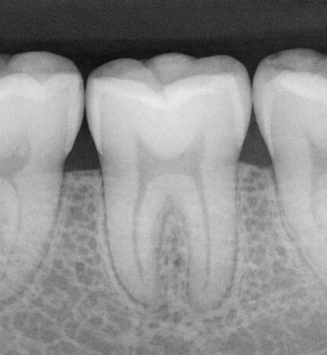 발산동 치과 씹을 때만 찌릿한 통증, 충치가 아닐 수 있습니다 — 치아 균열 증후군 관련 이미지 5