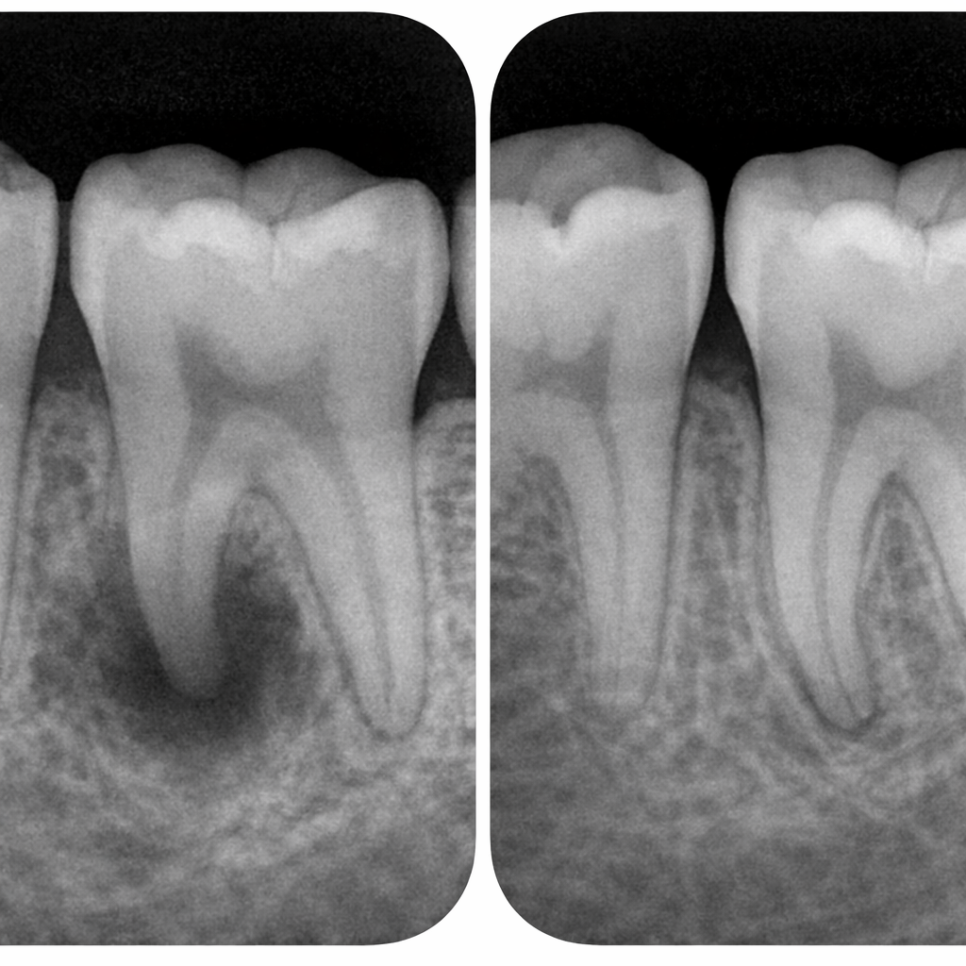 강서 치과 발치 즉시 임플란트, 나도 할 수 있을까? 가능한 조건과 장점 관련 이미지 2