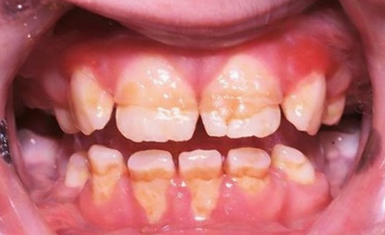 우장산역 치과 소아 신경치료, 유치는 곧 빠질텐데 꼭 받아야 될까? 관련 이미지 2