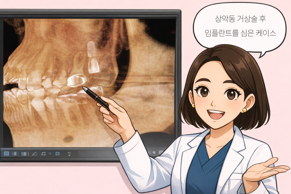 우장산 치과 상악동 거상술, 임플란트 전 꼭 해야 될까? 관련 이미지 5