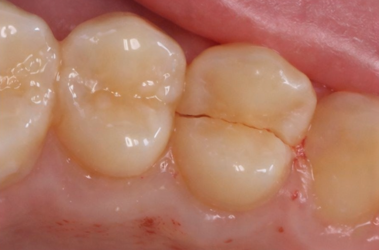 발산동 치과 씹을 때만 찌릿한 통증, 충치가 아닐 수 있습니다 — 치아 균열 증후군 관련 이미지 3