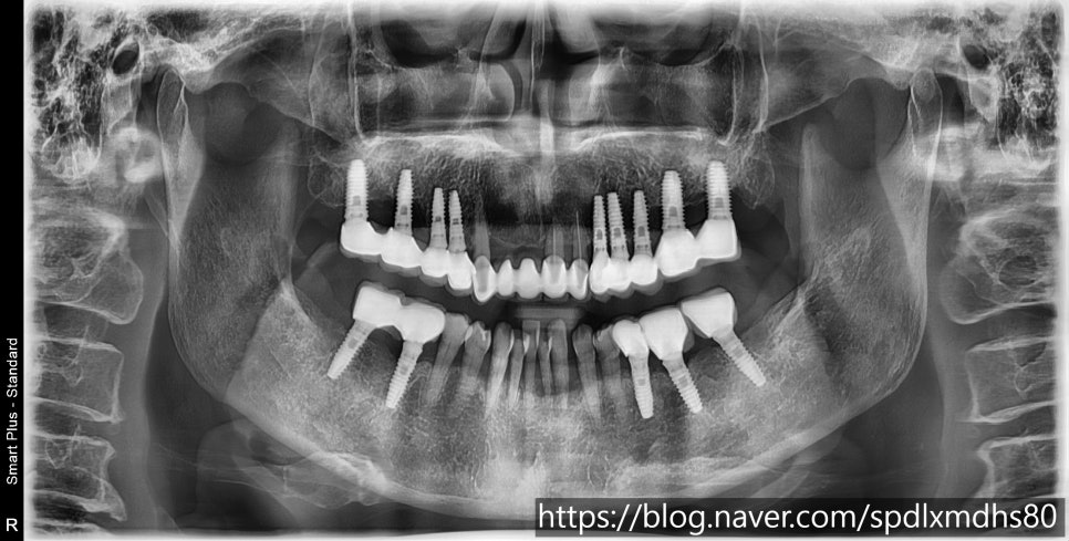 Gangseo-gu Dental Clinic: Can Implant Surgery Be Performed More Accurately and Comfortably? image 2