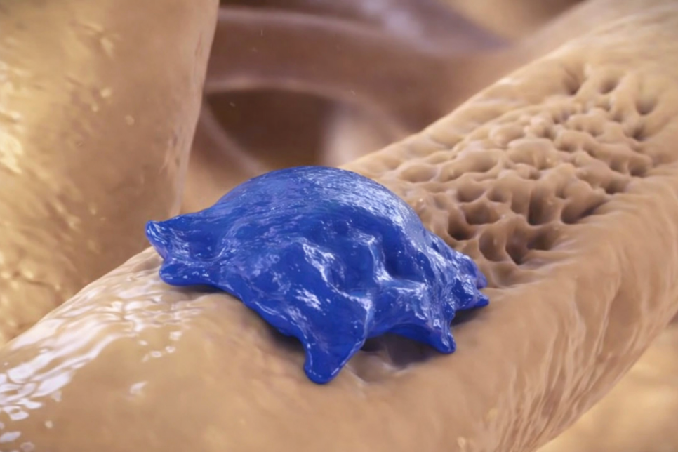 우장산 치과 발치 후 임플란트 안 하면? 치아 정출 &bull; 치축 경사 &bull; 치조골 흡수 관련 이미지 3