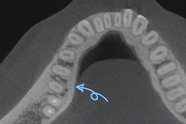 마곡동 치과 신경치료, 뿌리 모양이 이상하다면? MB2/Radix Entomolaris 관련 이미지 5