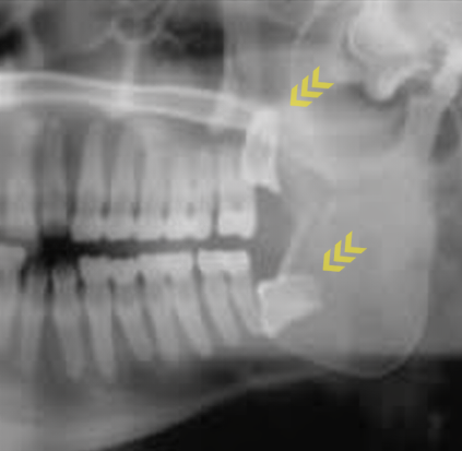 Maguok-dong Dental Clinic: If your gum keeps swelling around your wisdom tooth, let’s look at the causes of pericoronitis and how to manage it! image 5