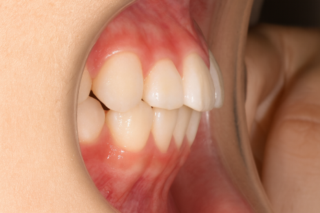 앞니 살짝 틀어짐, 발산동 치과 부분 교정 하고 싶은 분?! 관련 이미지 5