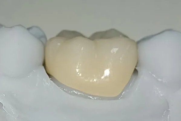The Difference Between Resin and Ceramic You Must Know Before Cavities Treatment at Balsan-dong Dental Clinic image 5