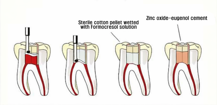 우장산역 치과 소아 신경치료, 유치는 곧 빠질텐데 꼭 받아야 될까? 관련 이미지 3