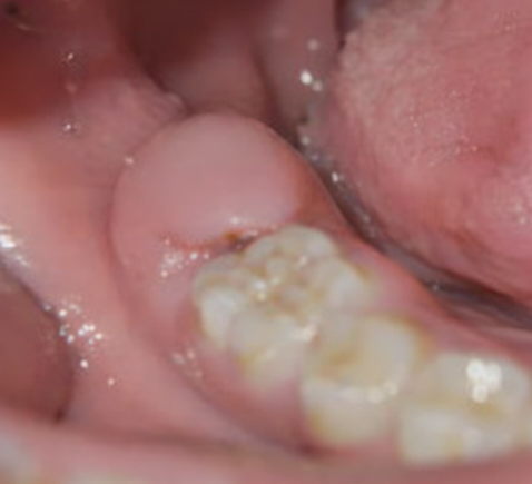 Maguok-dong Dental Clinic: If your gum keeps swelling around your wisdom tooth, let’s look at the causes of pericoronitis and how to manage it! image 2