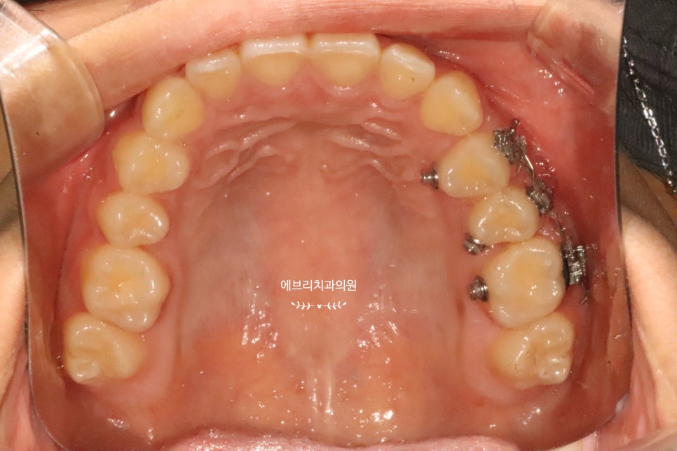 내발산동 치과,아이 치아가 안나와요. 그냥두면될까요? 관련 이미지 5