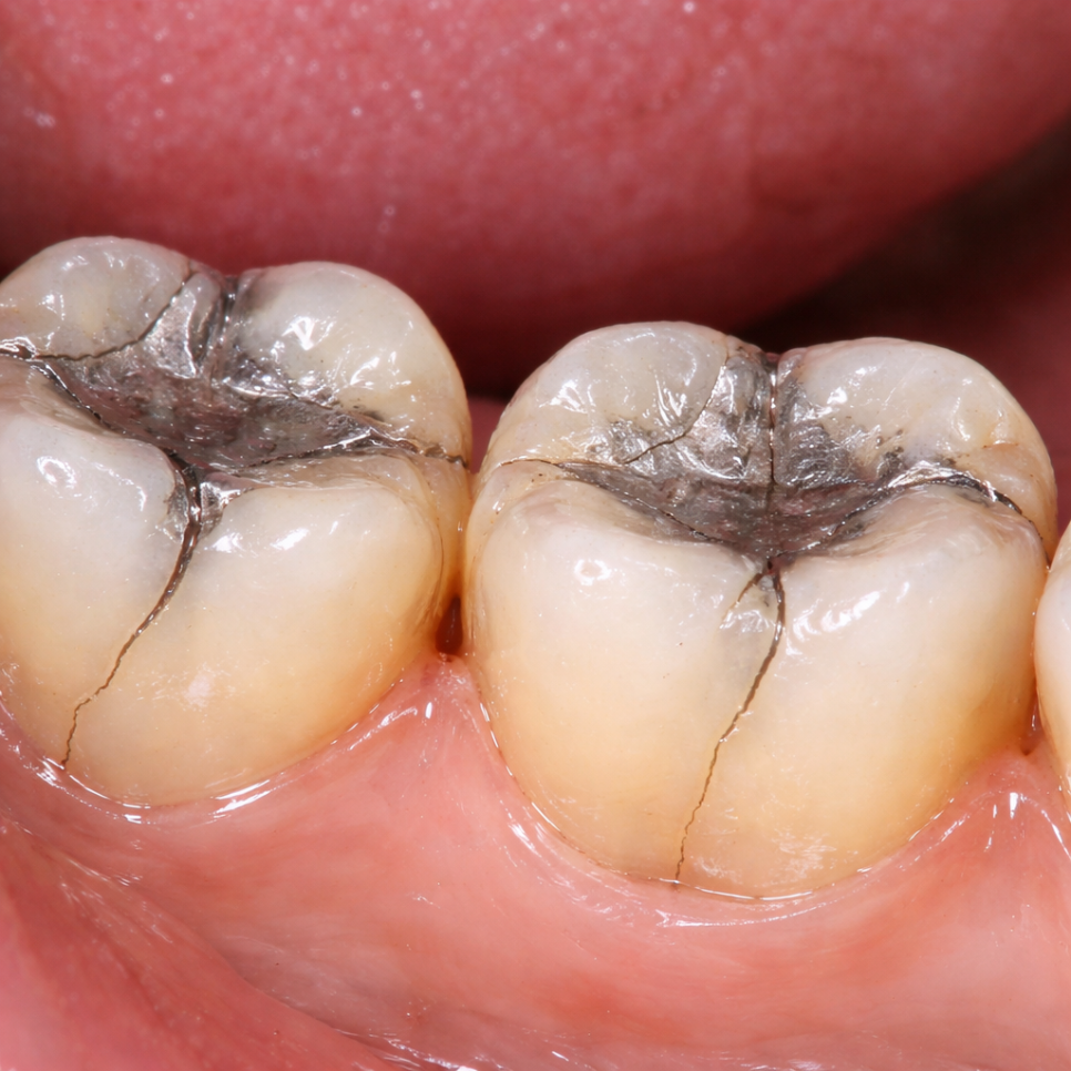 발산동 치과 씹을 때만 찌릿한 통증, 충치가 아닐 수 있습니다 — 치아 균열 증후군 관련 이미지 4