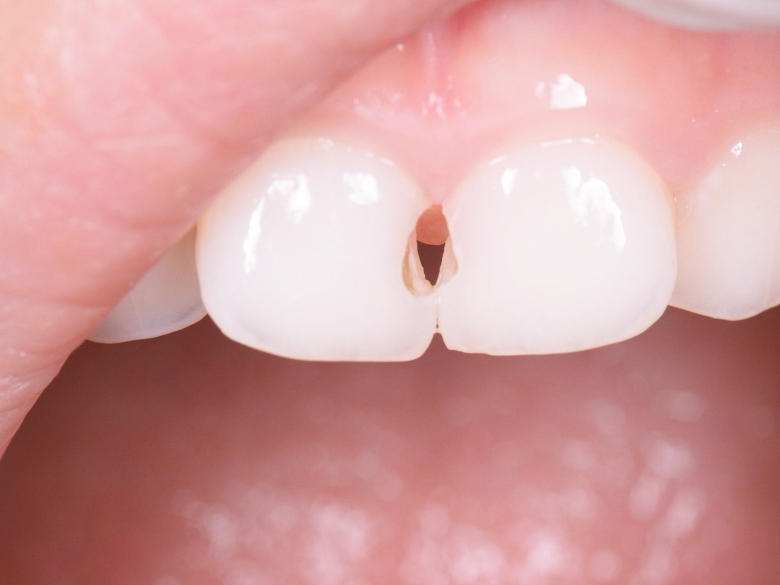 학생구강검진 여름시즌, 유치충치와 아이교정 꼭 확인하세요! 관련 이미지 4