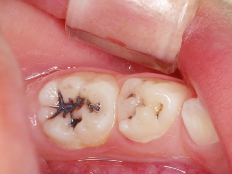 학생구강검진 여름시즌, 유치충치와 아이교정 꼭 확인하세요! 관련 이미지 3