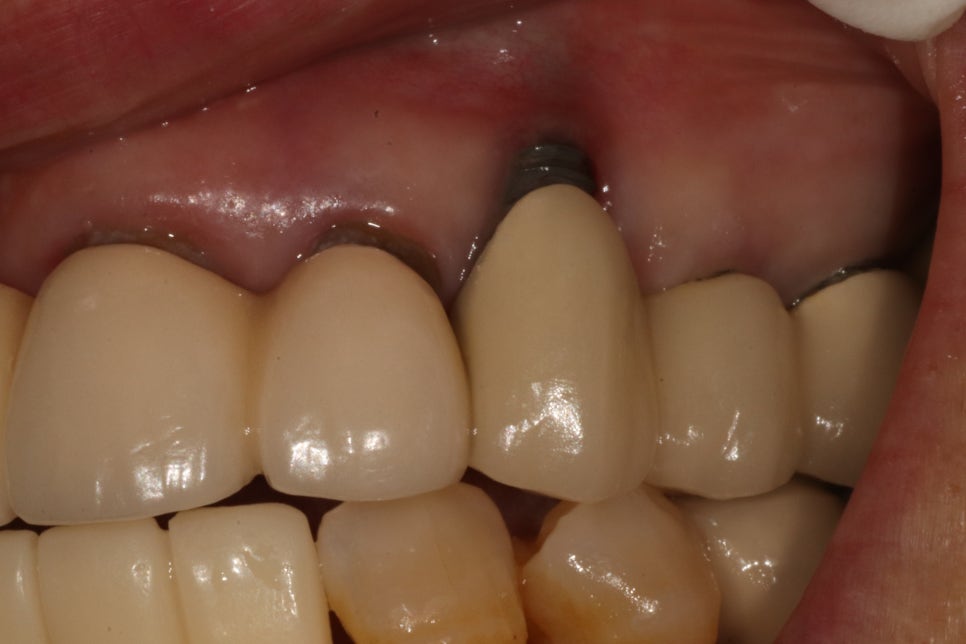 What Matters More Than the Price of Implants at Sumyeongsan Dental Clinic: What Should You Consider for Long-Term Use? image 2