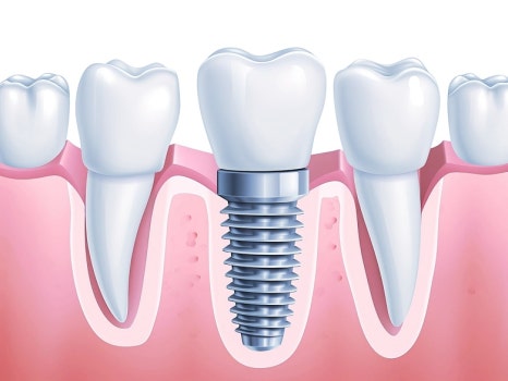 부모님의 구강 건강을 지켜드리며 배우는 것 관련 이미지 8