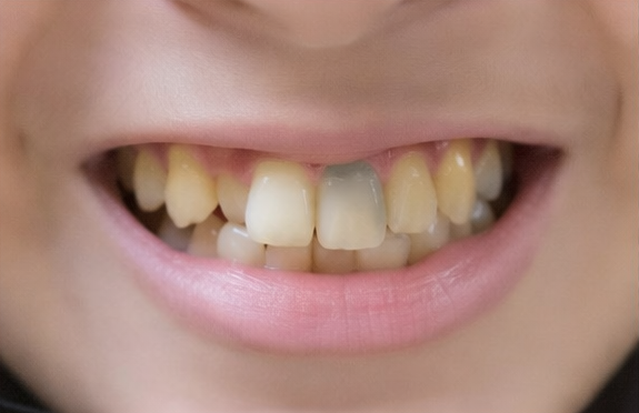 발산동 치과 전문의가 알려주는 치아 미백 완전 가이드 관련 이미지 2