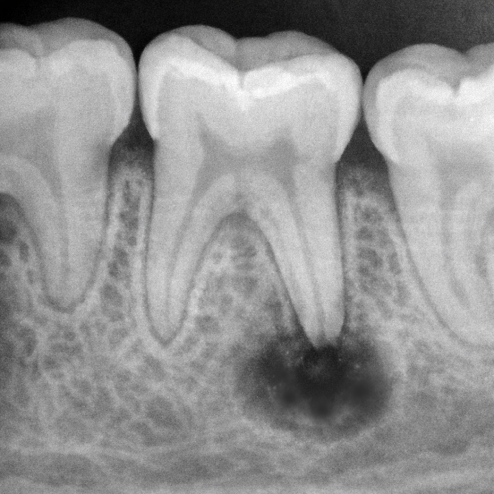 우장산역 치과 소아 신경치료, 유치는 곧 빠질텐데 꼭 받아야 될까? 관련 이미지 1