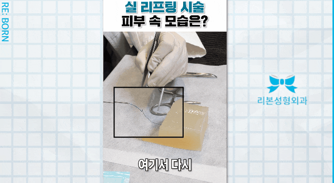 중안면거상술 물론 좋지만, 실리프팅을 조금 더 권하는 이유? 관련 이미지 4