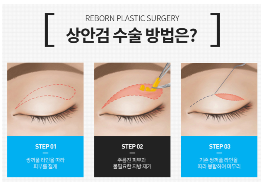 Organizing Midlife Eye Surgery in Sinsa-dong. image 3