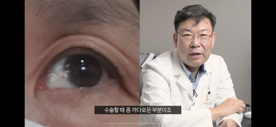 눈꺼풀처짐에 눈꺼풀실리프팅? 중년눈성형? 후기도 확인하자 관련 이미지 2