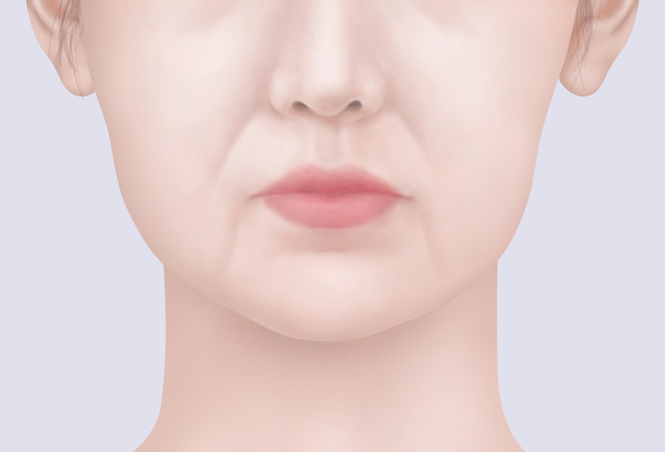 중안면거상술, 수술이 아닌 실리프팅으로 효과 볼 수 있을까? 관련 이미지 1