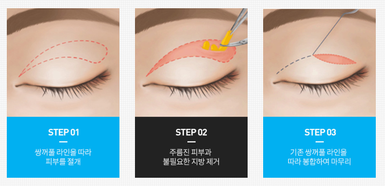 What Matters More Than the Price of Upper and Lower Eyelid Surgery? image 2