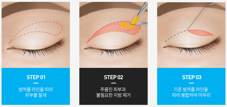 신논현성형외과? 상안검, 하안검 관련 이미지 2