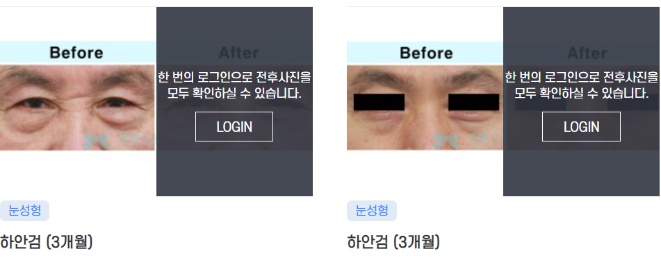 Apgujeong Middle-Aged Eye Surgery: Refined and Elegant image 3